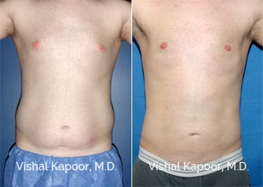 Patient 01 Front View Male Breast Reduction Beverly Hills Cosmetic Plastic Surgery Doc