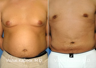 Patient 02 Front View Male Breast Reduction Beverly Hills Cosmetic Plastic Surgery Doc