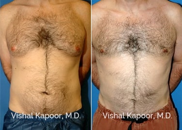 Patient 03 Front View Male Breast Reduction Beverly Hills Cosmetic Plastic Surgery Doc