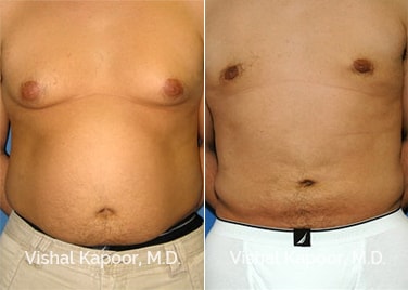 Patient 01 Front View Liposuction Beverly Hills Cosmetic Plastic Surgery Doc