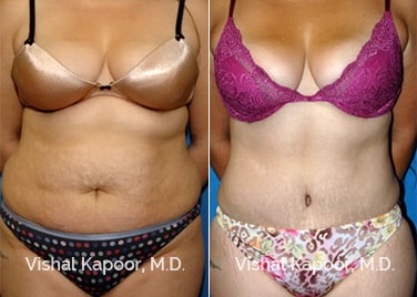 Patient 07 Front View Liposuction Beverly Hills Cosmetic Plastic Surgery Doc