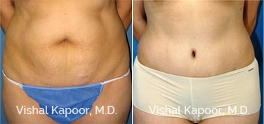 Patient 14 Front View Liposuction Beverly Hills Cosmetic Plastic Surgery Doc