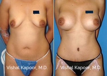 Patient 02 Front View Tummy Tuck Beverly Hills Cosmetic Plastic Surgery Doc