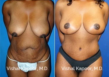 Patient 03 Front View Tummy Tuck Beverly Hills Cosmetic Plastic Surgery Doc