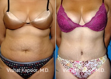 Patient 04 Front View Tummy Tuck Beverly Hills Cosmetic Plastic Surgery Doc