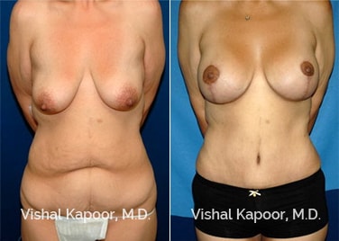 Patient 06 Front View Tummy Tuck Beverly Hills Cosmetic Plastic Surgery Doc