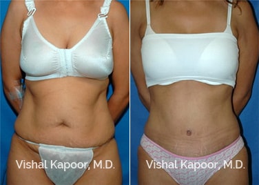 Patient 07 Front View Tummy Tuck Beverly Hills Cosmetic Plastic Surgery Doc