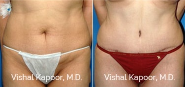 Patient 17 Front View Tummy Tuck Beverly Hills Cosmetic Plastic Surgery Doc