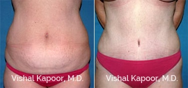 Patient 20 Front View Tummy Tuck Beverly Hills Cosmetic Plastic Surgery Doc