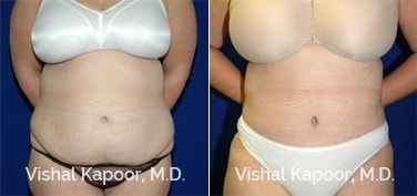 Patient 22 Front View Tummy Tuck Beverly Hills Cosmetic Plastic Surgery Doc