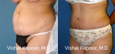 Patient 23 Front View Tummy Tuck Beverly Hills Cosmetic Plastic Surgery Doc