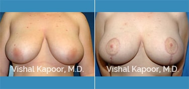 Patient 03 Front View Breast Lift Beverly Hills Cosmetic Plastic Surgery Doc