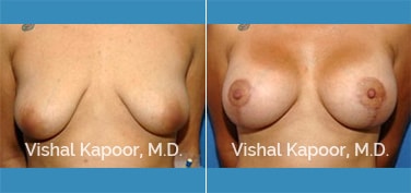 Patient 04 Front View Breast Lift Beverly Hills Cosmetic Plastic Surgery Doc