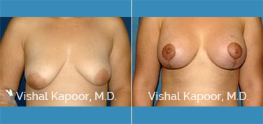 Patient 09 Front View Breast Lift Beverly Hills Cosmetic Plastic Surgery Doc