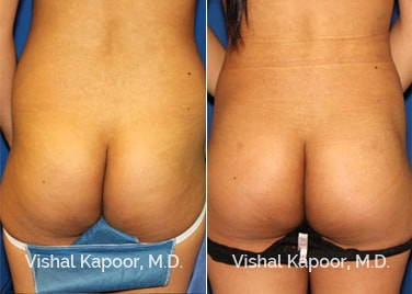 Patient 01 Back View Brazilian Butt Lift Beverly Hills Cosmetic Plastic Surgery Doc