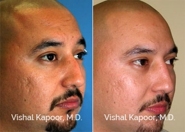 Patient 02 3/4 View Revision Rhinoplasty Beverly Hills Cosmetic Plastic Surgery Doc