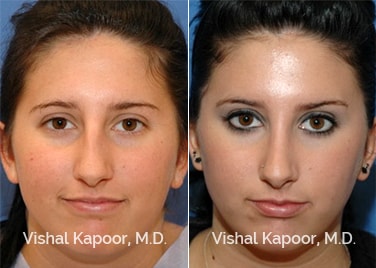 Patient 05 Front View Revision Rhinoplasty Beverly Hills Cosmetic Plastic Surgery Doc