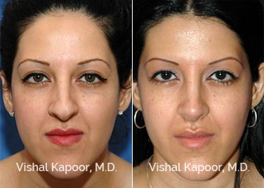 Patient 06 Front View Revision Rhinoplasty Beverly Hills Cosmetic Plastic Surgery Doc
