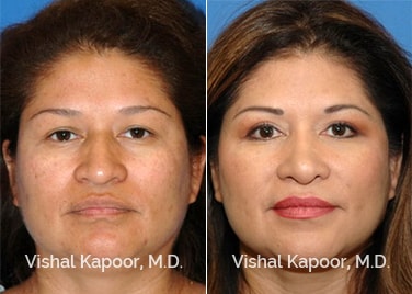 Patient 07 Front View Revision Rhinoplasty Beverly Hills Cosmetic Plastic Surgery Doc