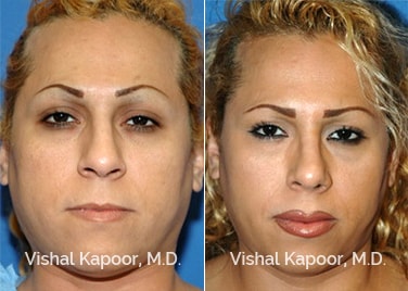 Patient 08 Front View Revision Rhinoplasty Beverly Hills Cosmetic Plastic Surgery Doc