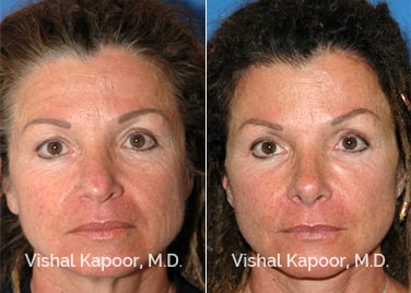 Patient 09 Front View Revision Rhinoplasty Beverly Hills Cosmetic Plastic Surgery Doc