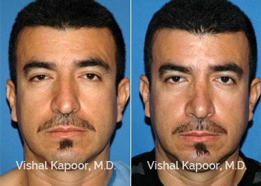 Patient 10 Front View Revision Rhinoplasty Beverly Hills Cosmetic Plastic Surgery Doc