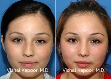 Patient 11 Front View Revision Rhinoplasty Beverly Hills Cosmetic Plastic Surgery Doc