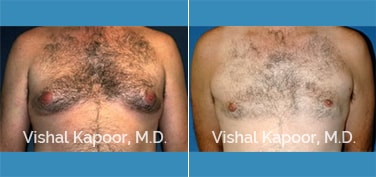 Patient 05 Front View Male Breast Reduction Beverly Hills Cosmetic Plastic Surgery Doc