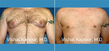 Patient 06 Front View Male Breast Reduction Beverly Hills Cosmetic Plastic Surgery Doc