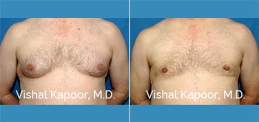 Patient 07 Front View Male Breast Reduction Beverly Hills Cosmetic Plastic Surgery Doc