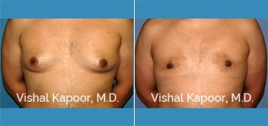 Patient 08 Front View Male Breast Reduction Beverly Hills Cosmetic Plastic Surgery Doc