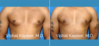 Patient 10 Front View Male Breast Reduction Beverly Hills Cosmetic Plastic Surgery Doc