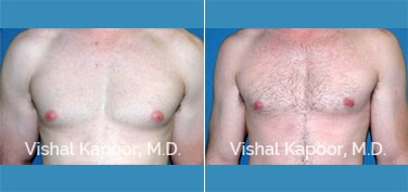 Patient 12 Front View Male Breast Reduction Beverly Hills Cosmetic Plastic Surgery Doc