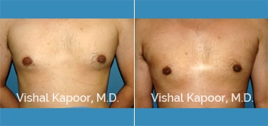 Patient 13 Front View Male Breast Reduction Beverly Hills Cosmetic Plastic Surgery Doc