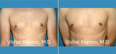 Patient 14 Front View Male Breast Reduction Beverly Hills Cosmetic Plastic Surgery Doc