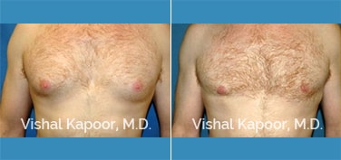 Patient 15 Front View Male Breast Reduction Beverly Hills Cosmetic Plastic Surgery Doc
