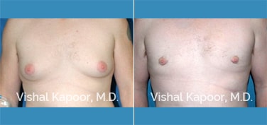 Patient 16 Front View Male Breast Reduction Beverly Hills Cosmetic Plastic Surgery Doc