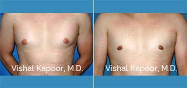 Patient 17 Front View Male Breast Reduction Beverly Hills Cosmetic Plastic Surgery Doc