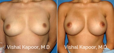 Patient 21 Front View Breast Augmentation Beverly Hills Cosmetic Plastic Surgery Doc