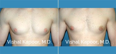 Patient 18 Front View Male Breast Reduction Beverly Hills Cosmetic Plastic Surgery Doc