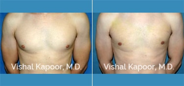 Patient 20 Front View Male Breast Reduction Beverly Hills Cosmetic Plastic Surgery Doc