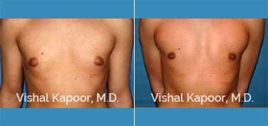 Patient 21 Front View Male Breast Reduction Beverly Hills Cosmetic Plastic Surgery Doc