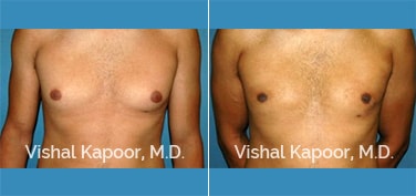 Patient 23 Front View Male Breast Reduction Beverly Hills Cosmetic Plastic Surgery Doc