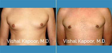 Patient 24 Front View Male Breast Reduction Beverly Hills Cosmetic Plastic Surgery Doc