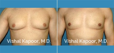 Patient 25 Front View Male Breast Reduction Beverly Hills Cosmetic Plastic Surgery Doc