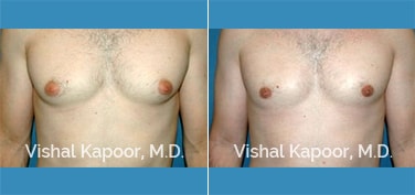 Patient 26 Front View Male Breast Reduction Beverly Hills Cosmetic Plastic Surgery Doc