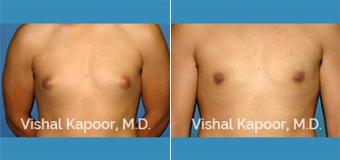 Patient 27 Front View Male Breast Reduction Beverly Hills Cosmetic Plastic Surgery Doc