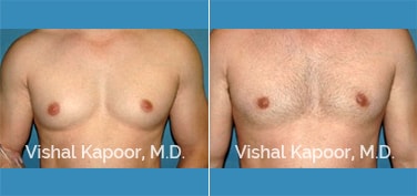 Patient 29 Front View Male Breast Reduction Beverly Hills Cosmetic Plastic Surgery Doc