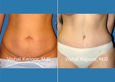 Patient 11 Front View Tummy Tuck Beverly Hills Cosmetic Plastic Surgery Doc