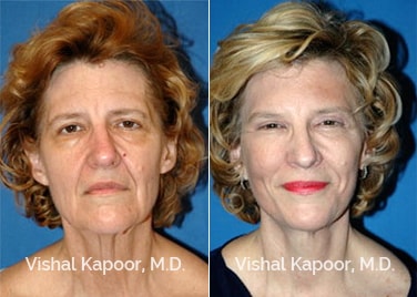 Patient 02 Front View Face Neck Rejuvenation Beverly Hills Cosmetic Plastic Surgery Doc